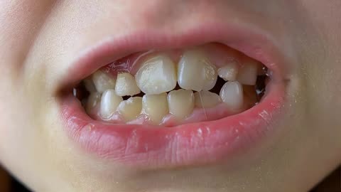 宝宝牙齿出现白斑,原来是牙齿脱矿了!